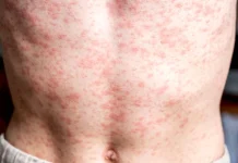 El sarampión volvió a las Américas, advierte la OPS