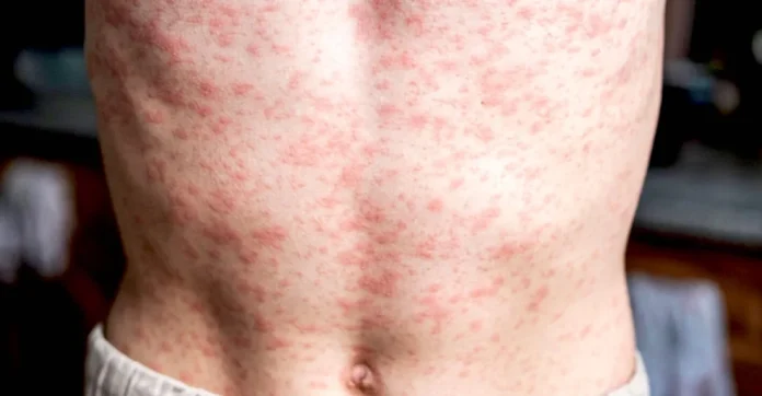 sarampion-1-1100x572